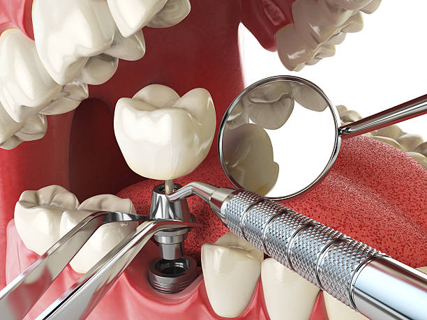 Best Broken Tooth Emergency  in Harbison Nyon, CA